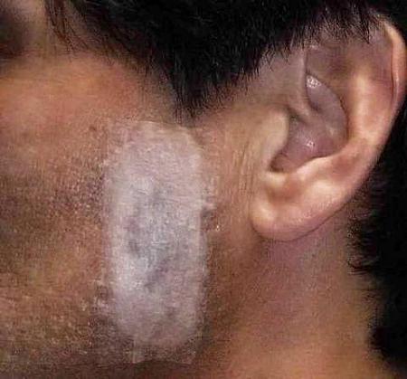 手術後